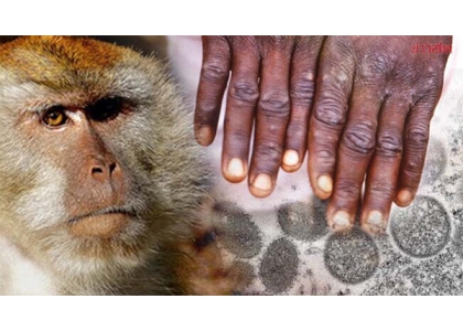 2023–07-05 政府警告猴痘病例激增，建议规避风险行为